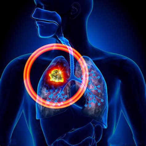 肺癌为什么会产生肩背部疼痛,是因为侵犯或者转移到这些组织有关 - 微医（挂号网）