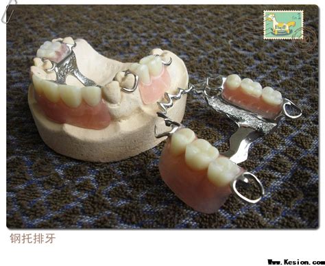 钢托活动牙图片,胶托义齿图片,单颗动义齿(第9页)_大山谷图库