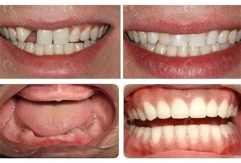 种植牙和镶假牙有什么区别,种植牙贵还是镶牙贵_多优仕口腔