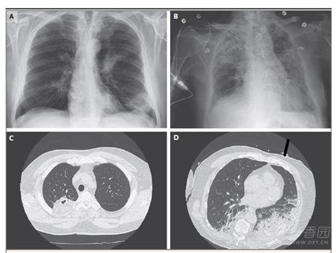 Review: 吸入性肺炎 - 呼吸与胸部疾病讨论版 -丁香园论坛