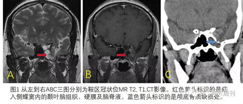 脑脊液鼻漏图片