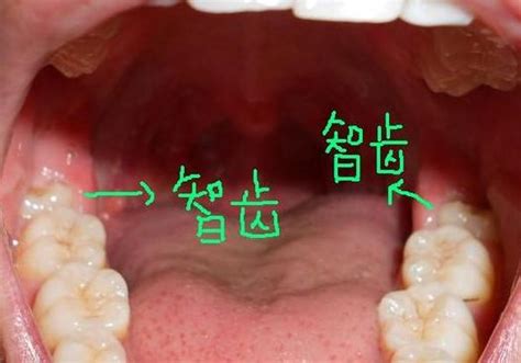 智齿发炎图片