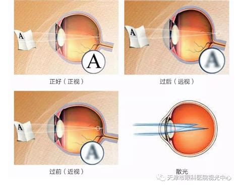 眼睛结构你了解吗？究竟什么是屈光不正？__凤凰网