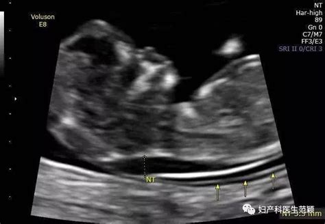孕11-14周为什么要做超声测NT？|超声|NT|胎儿|畸形|颈部|-健康界
