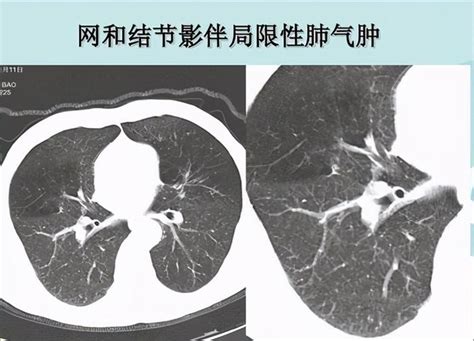 胸部CT之肺和肺的分叶_医学界-助力医生临床决策和职业成长