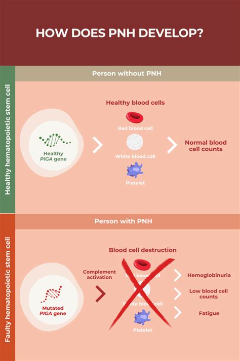 What Is Paroxysmal Nocturnal Hemoglobinuria (PNH)? | PNH News