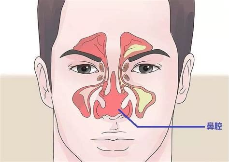 鼻窦炎图片