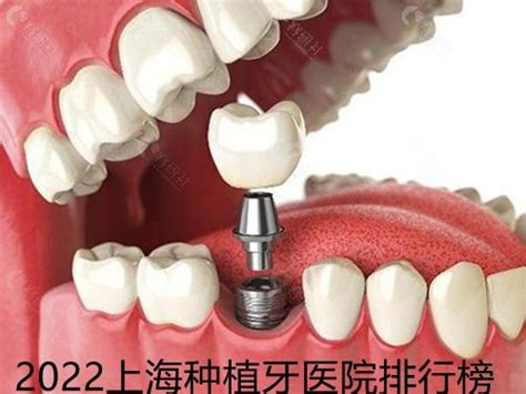 2022上海种植牙医院排行榜，排名前十的这几家种牙便宜又好 - 爱美容研社