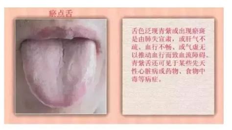 舌诊浅析：舌头有齿痕，舌面裂纹以及舌尖红点