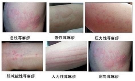 过敏性风团图片