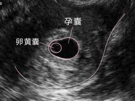 怀孕48天B超孕囊大小2.7x1.3x4.3哪位高人指点一下看孕囊是男孩还是女孩，B超的照片看照片像是茄子形状的 - 百度宝宝知道