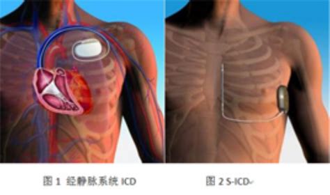 植入式心脏起搏器 ULTRA DR 1291 乐普-心脏起搏器-寰熙医疗