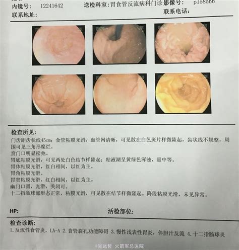 食管裂孔疝图片