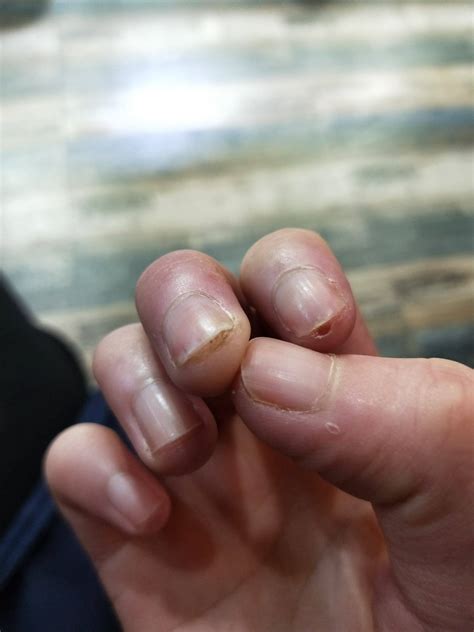 灰指甲初期的症状-灰指甲症状-复禾健康