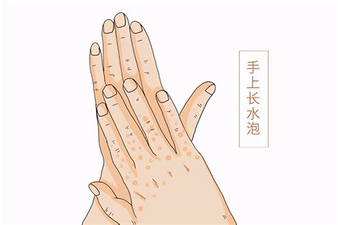 手指汗疱疹怎么治疗最有效（夏季是"汗疱疹"高发季节，手上出现密密麻麻小水泡，该怎么办？） | 说明书网