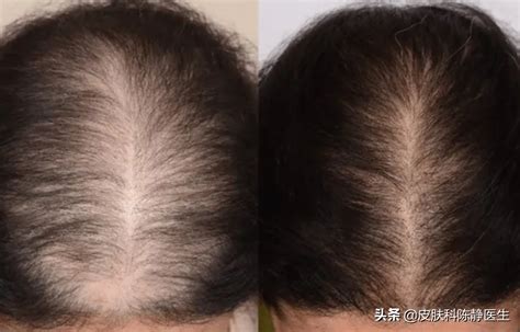 植发可以有效治疗男性雄激素脱发,植发后新头发也不易掉哦 - 脱发知识 - 毛毛网