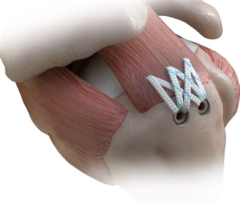 固定韧带铆钉图片