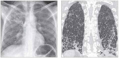 支气管肺炎、社区/医院获得性肺炎丨影像表现_患者_显示_右肺