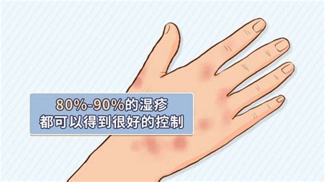 中华医学会 科普图文 可恶又麻烦的湿疹，到底能不能根治？