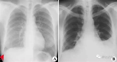 【X线诊断要点】胸腔积液与气胸的程度如何判定？