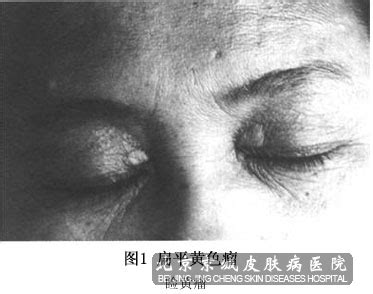 黄瘤病图片