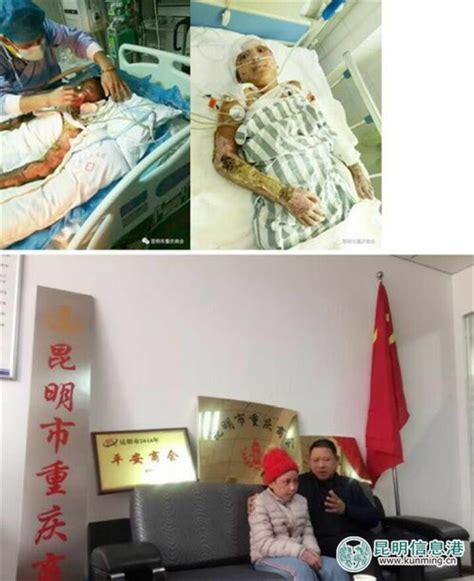 云南省慈善总会和昆明重庆商会联合捐助烧伤女孩