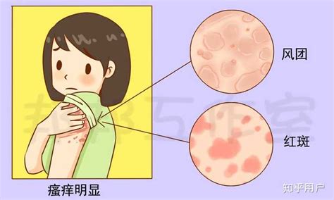 药物过敏皮疹图片