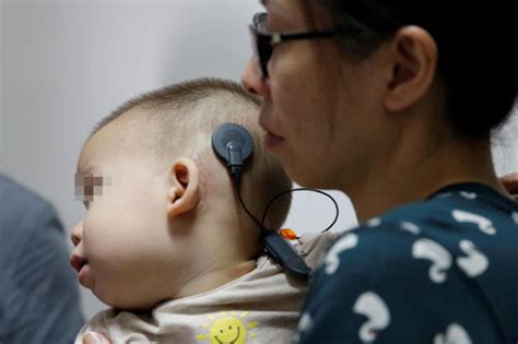 广东医生完成全球首例最小龄共同腔畸形同期双侧人工耳蜗植入术_家庭医生在线新闻频道