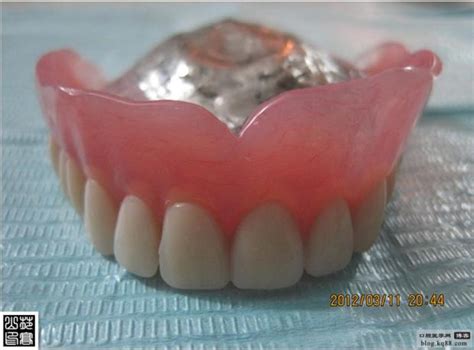 纯钛支架：一种理想的活动义齿修复方式-严明的博客-KQ88口腔博客