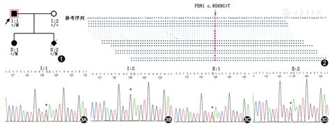 马凡综合征一家系的FBN1致病基因突变分析及产前诊断 - 中华医学杂志