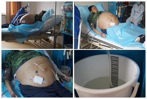 轻度肚子腹水图片