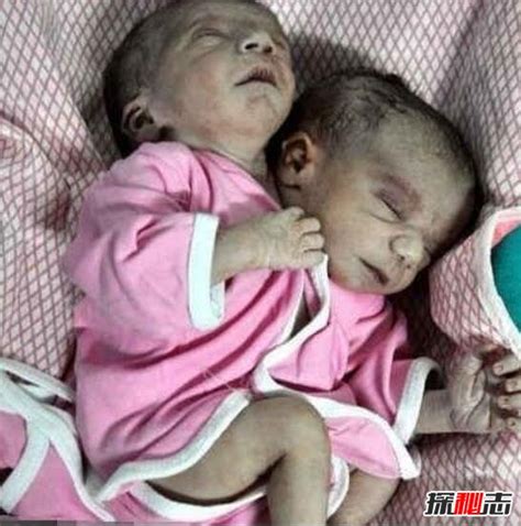 巴西双头婴儿意外诞生，两个头颅共用一个身体(依旧存活)_小狼观天下
