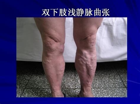 下肢静脉血栓图片