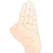 爪形手常见于,爪形手和猿形手图片,爪形手和猿手(第3页)_大山谷图库