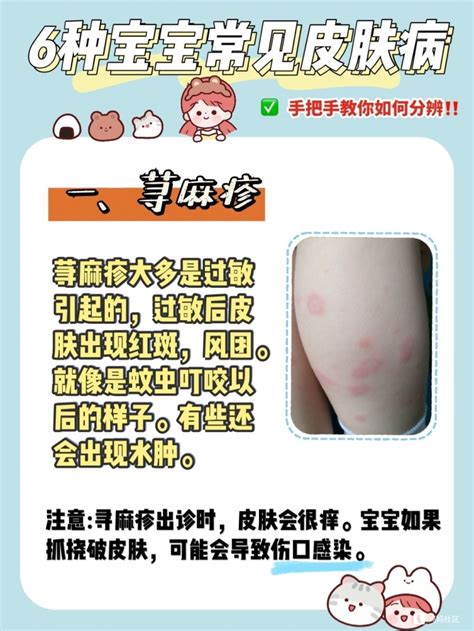 各类疹子识别图图片