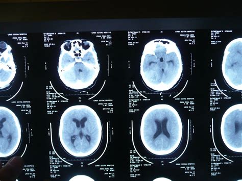 Science Advances：通往治疗脑肿瘤的钥匙–突破血脑屏障 – 肽度TIMEDOO
