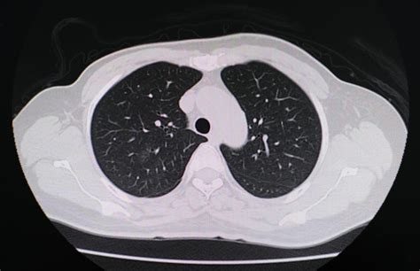 6类人感染新冠更易“白肺”，不想得“白肺”一定要注意这3点_澎湃号·湃客_澎湃新闻-The Paper