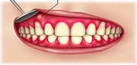 牙龈肿了个肉坨怎么办？如果是牙龈瘤的话会自己消退吗？,牙齿保养-8682赴韩整形网