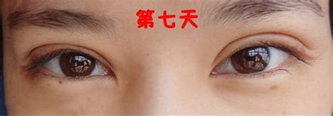 韩式三点微创双眼皮手术恢复过程图片_有来医生