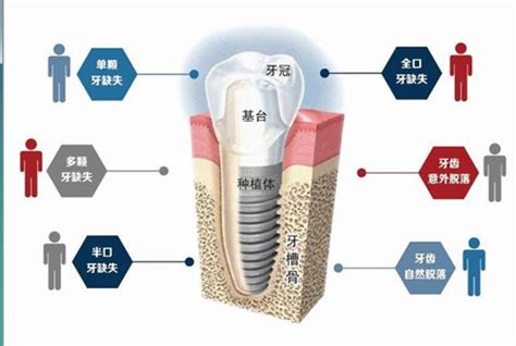 种牙图片