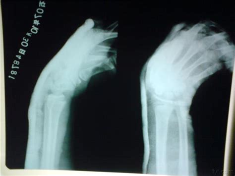 左手桡骨远端骨折拆石膏后手腕不能转动_第二人生