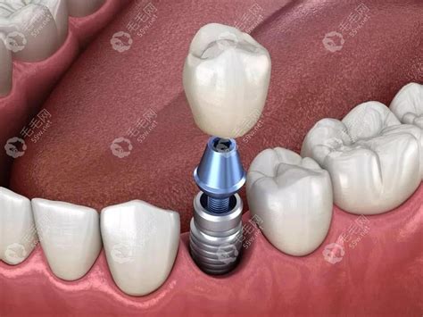 牙齿种植_种植牙技术_种植牙价格_种植牙要多少钱-美奥口腔