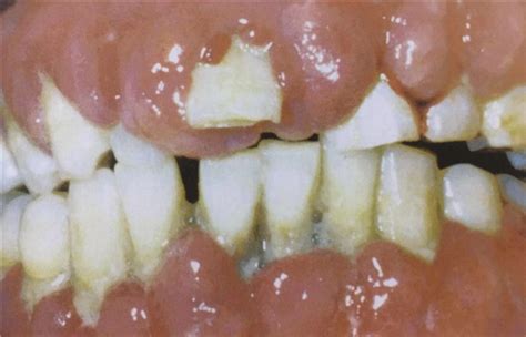 牙龈肿可以补牙吗(牙龈肿痛怎么进行治疗？) | 说明书网
