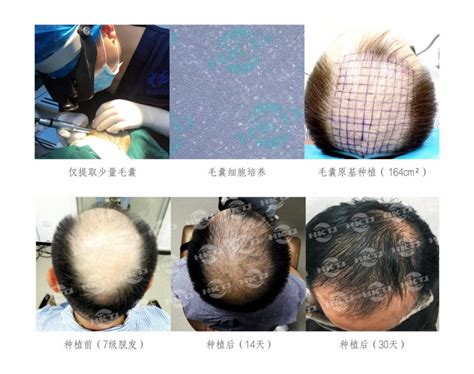自研自体毛囊再生种植技术，「华科同济干细胞」成功临床应用大面积植发_创氪_中国网