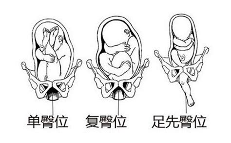 胎位图图片