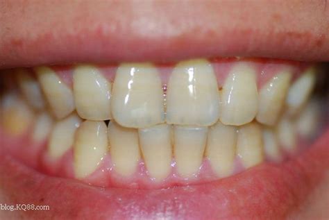 (种植覆盖义齿)半固定种植牙和活动假牙的区别有以下5点 - 口腔资讯 - 牙齿矫正网