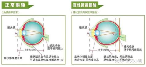 近视的孩子写作业要不要戴眼镜？--晋城市眼科医院