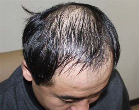 脂溢性脱发去哪里治疗比较好,遗传性脂溢性脱发到底能治好 - 知乎