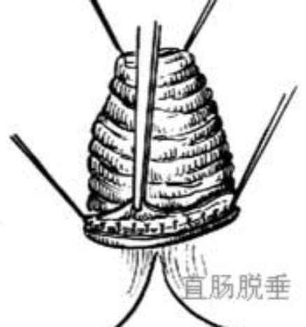 直肠脱垂图片
