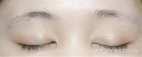 北京植眉科普：眉毛稀疏、短缺、不好看？建议植眉来调整 - 知乎